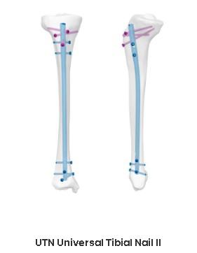 Універсальний великогомілковий стрижень з подовжуючою заглушкою (Double Medical Technology Inc.)